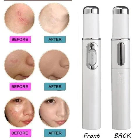 Blue Light Therapy Acne Laser Pen - Scar & Blemish Reduction - Image 2