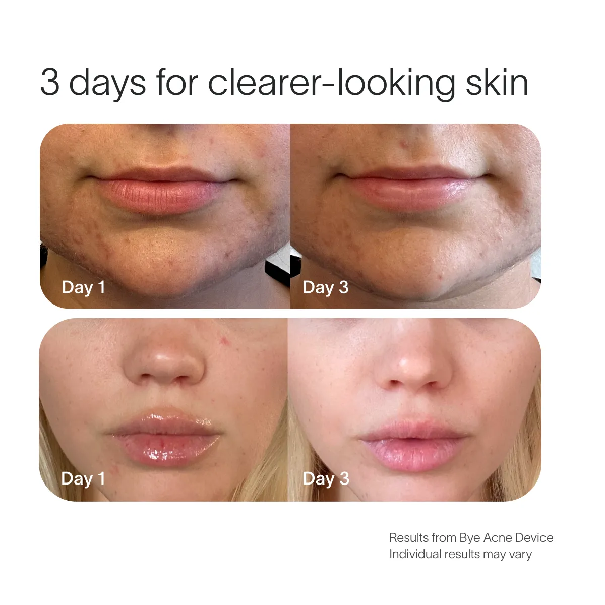 Bye Acne Pro Kit - Image 12