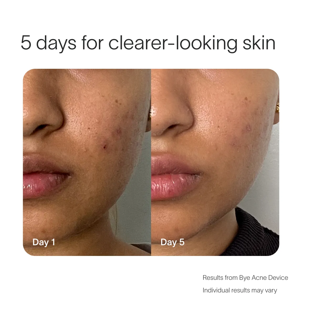 Bye Acne Pro Kit - Image 2